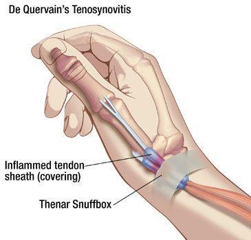 de Quervain s De Quervain s Tenosynovitis (D-quare-vanes T-no-sigh-no-vie-tis) is inflammation of the tendons on the side of your wrist, at the base of your thumb.