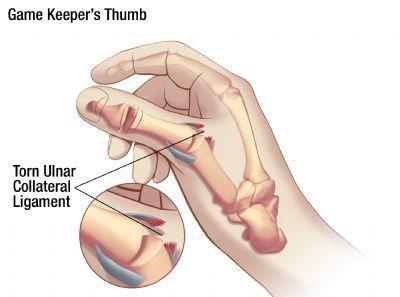 Gamekeeper s or Skier s Thumb Gamekeeper s thumb is an injury that happens when your thumb is pushed sideways, away from the index finger, tearing the ligaments between the bones in your thumb.