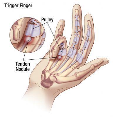 Trigger Thumb Trigger Thumb is an inflammatory condition that affects the tendons that flex or bend your thumb.