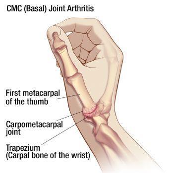 CMC Joint Arthritis Thumb Arthritis When you think about arthritis, normally you think about your knees, hips or even your fingers.