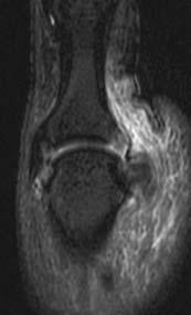 Stener Lesion MR imaging can depict UCL Adductor Aponeurosis