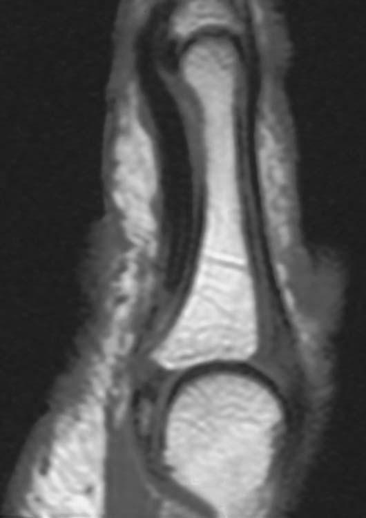 Flexor Tendon Tears Often difficult to diagnose and fully characterize clinically MR