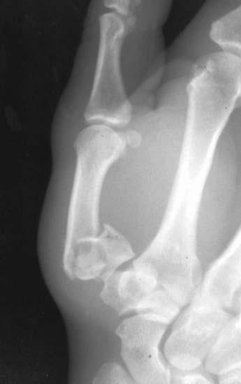 Rolando Fracture Originally described - Y-shaped 3-fragment fracture Extended to the articular