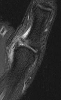 Gamekeeper s Thumb MR or MR arthrography Accurately demonstrate the