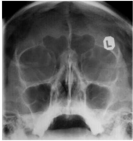Plain Film: Waters View Frontal Sinus Orbit Nasal septum Maxillary Sinus Maxillary