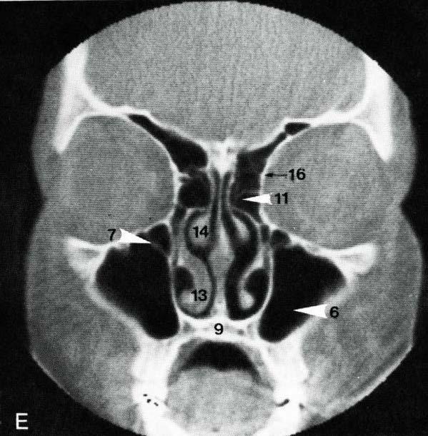 Anatomy on Coronal CT Cribiform Plate Frontal Sinus Temporal Bone Orbit Lamina Papyracea Ethmoid Sinus Nasal Septum Maxillary