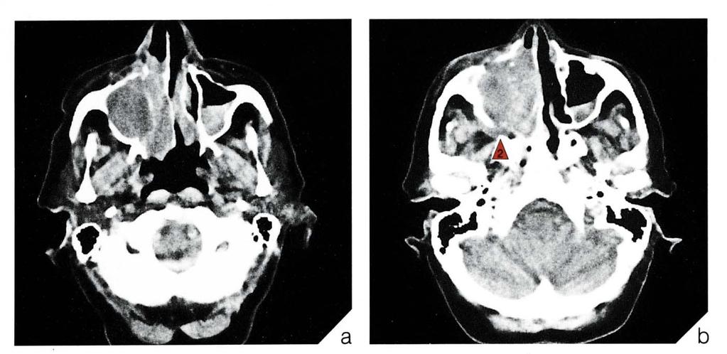 Companion Patient #1: Axial CT Destructive bone changes: SCC in R maxilla of 77 y/o woman, Note destruction of posterior