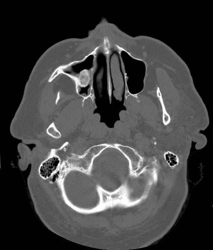 Mr. R: Axial CT Findings: High-attenuation mass Floor of R maxillary sinus 1.8 x 1.
