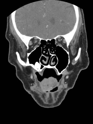 Mr. R: Coronal CT PACS, BIDMC Findings: High-attenuation mass Floor of R maxillary sinus 1.8 x 1.