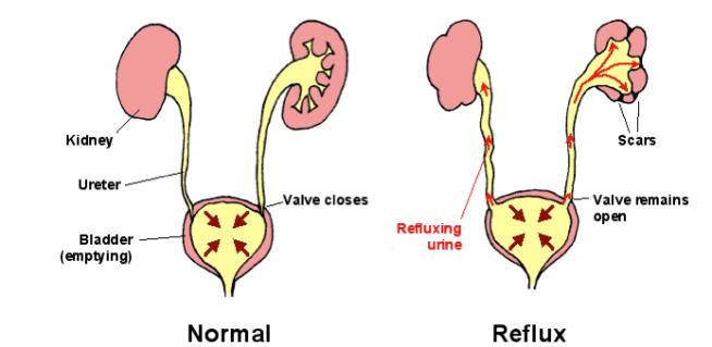 reflux, inducing severe renal damage muscle its function depends on proper insertion of the ureter orifice in the bladder failure in urinary tract