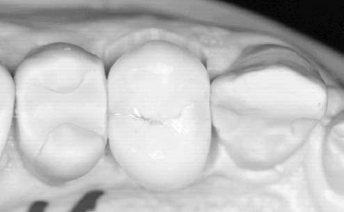Fig. 40: Crown on the master cast Fig. 41: Crown (14) after permanent cementing. Tooth 15 was restored with composite Fig.