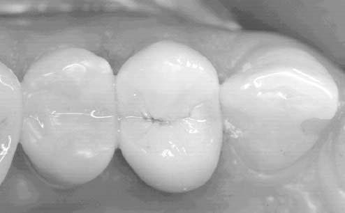 Volker Bonatz, Landau) After post preparation on tooth 15, an impression is taken with 3M TM ESPE TM Impregum TM Penta TM DuoSoft TM (Fig. Bonatz 41, Fig.