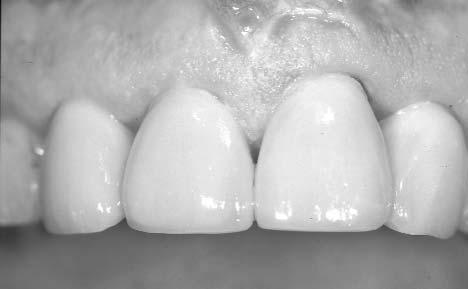 58: Intraoral situation Clinical Case Report-Porcelain Fused to Metal PFM)