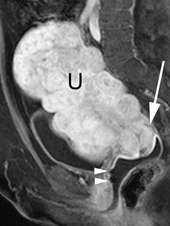 Sagittal T2- weighted image with vaginal gel allows better visualization of external cervical contour (arrowheads) to help exclude mass. Fig.