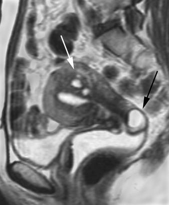 MRI of the Female Pelvis Fig. 7 Cervical endometriosis in 47-year-old woman with pelvic pain.