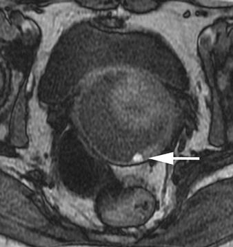 and, Sagittal () and oblique axial () T2-weighted images show small low-signal mass (arrow) in posterior vaginal fornix.