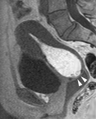 rown et al. Fig. 9 Cervical stenosis in 54-year-old woman with dyspareunia.