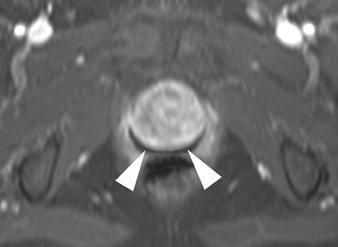 , Sagittal T2-weighted image shows heterogeneous mass (arrow) in region of