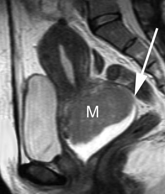 MRI of the Female Pelvis Downloaded from www.ajronline.org by 37.44.202.41 on 12/17/17 from IP address 37.44.202.41. Copyright RRS.