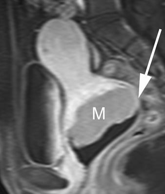 and, Sagittal T2-weighted () and postgadolinium fat-suppressed T1-weighted () images show large cervical mass (M)