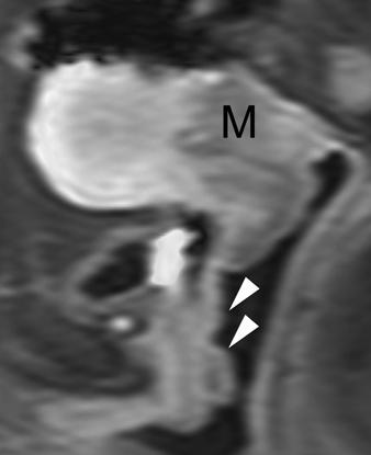 and, Sagittal T2-weighted () and postgadolinium fat-suppressed T1-weighted () images show cervical mass (M) that