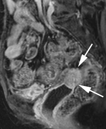 16 Recurrence of endometrial cancer at the vaginal cuff in 51-year-old woman.
