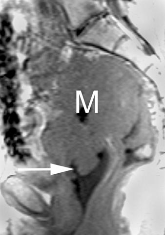 cause of hematometra in patients with benign cervical stenoses (Fig. 9). Fig. 17 Recurrence of ovarian cancer in 62-year-old woman.