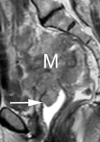Malignant Disease Distention of the vagina can often aid diagnosis and staging of pelvic cancers. In urethral cancer (Fig.