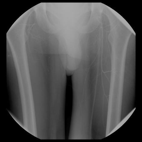 Subtraction Image Left superficial femoral a.