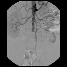Patient D.M.: Angiography Findings Complete occlusion of infrarenal aorta Extensive collateral circulation Pelvis: Superior rectal a. internal iliac a. LLE: Lumbar a. deep iliac circumflex a.