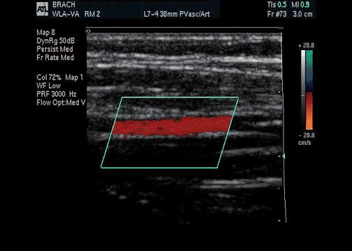 Non-Invasive Imaging: Doppler Ultrasound Goal Non-invasive evaluation of location, number, and severity
