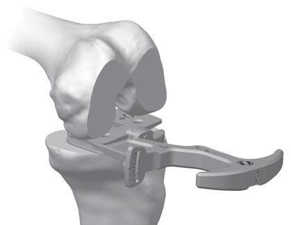 SECTION 5 Spacer Block with Sizer 3. Flexion Gap and Setting Femoral Rotation Remove the Spacer Block from the extension gap. Dissassemble the +9mm Femoral Paddle from +0mm Femoral Paddle.