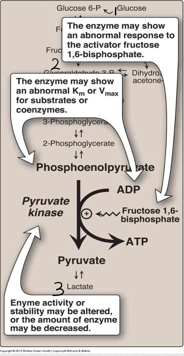 Pyruvate kinase Deficiency Hemolytic Anemia Pyruvate kinase mutation may lead to: 1. Altered responses to activator. 2. Altered enzyme kinetics. 3.