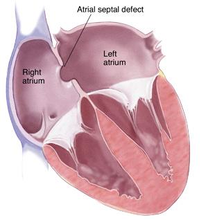 Atrial Septal Defect Early-mid systolic ejection murmur at LUSB = pulmonary flow murmur Fixed split S2 Right ventricular impulse ECG: