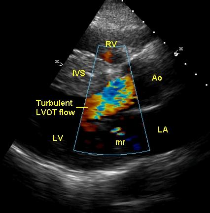 Subaortic Membrane Harsh quality Loudest at URSB, radiates to neck Often associated with aortic regurgitation (diastolic