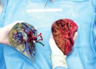 Liver 1-year adult patient survival by liver transplant type, 2011-* 3-year adult liver patient survival n Cleveland Clinic observed n Cleveland Clinic expected 90 n U.S.