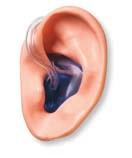 Custom Earmold Styles RIC Earmold RIC Open Earmolds are a hollow canal style shell in hard acrylic created with Digital SLS. These earmolds fit all NuEar RIC hearing instruments.