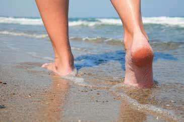 or blisters Avoid sunburn by applying high factor sun cream to all areas of your feet, except between your toes.