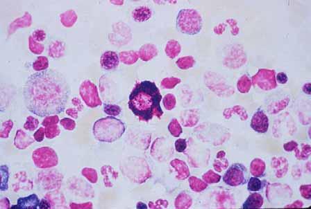Mast Cells Mast cells are formed in the tissue from undifferentiated bone marrow precursor cells released into the blood.