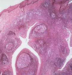 Secondary Lymphoid Tissue Tonsils