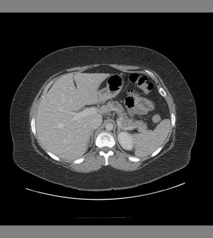Pancreas Anatomy: Axial CT