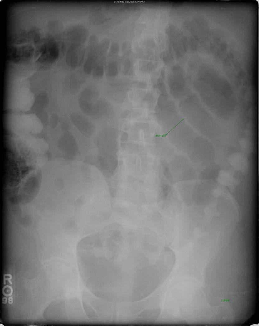 Patient R: Abdominal Plain Film HD 5 Transverse colon shows no marked distention but with no contrast spasm of the desc.