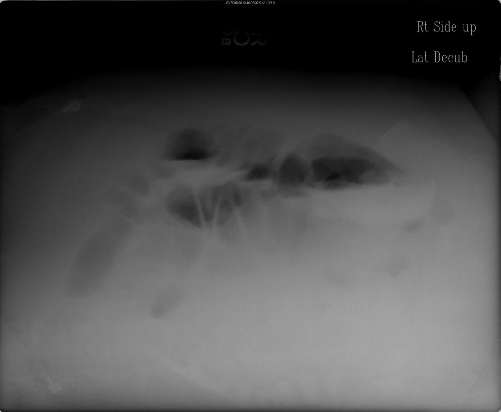 Patient R Abdominal Plain Film HD 5 Air fluid levels