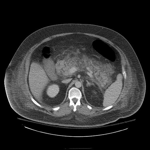 Patient R: Abdominal CT peripancreatic fat stranding