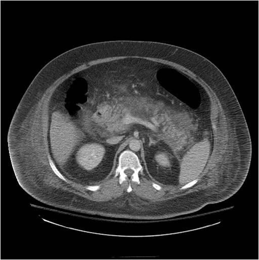 patent splenic vein Axial Delayed Phase CT: Patient R