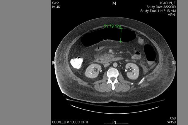 Patient R Abdominal CT: Focal Transverse Ileus and