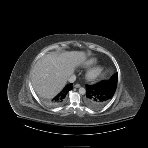 and pleural effusions Patient R: Frontal CXR Images from: PACS, BIDMC