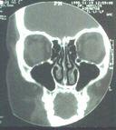 Normal Sinus CT Scan