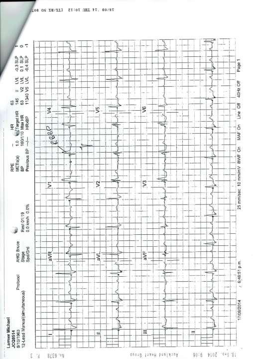 ECG and