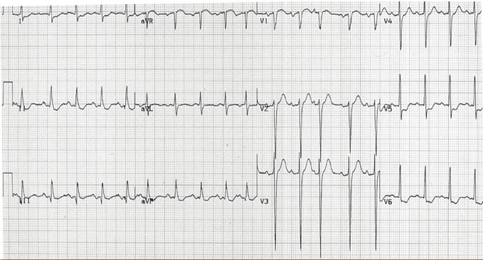 1. This patient s history and ECG are most consistent with which one of the following? 1% A. Esophageal spasm 36% B. Acute ST segment elevation MI (STEMI) 60% C.